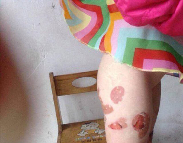 女子大腿多处被烫伤.