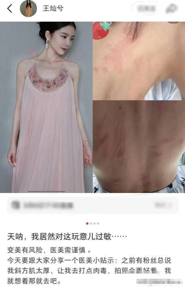 杜淳老婆医美翻车，王灿打肉毒素过敏进医院，后背全是红色抓痕