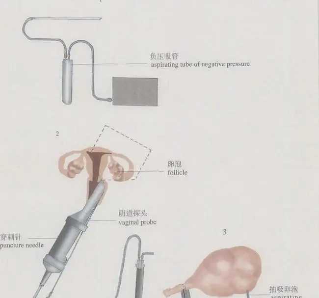 全程干货（骗前任怀孕了要分手费）骗前任怀孕怎么圆谎 第15张