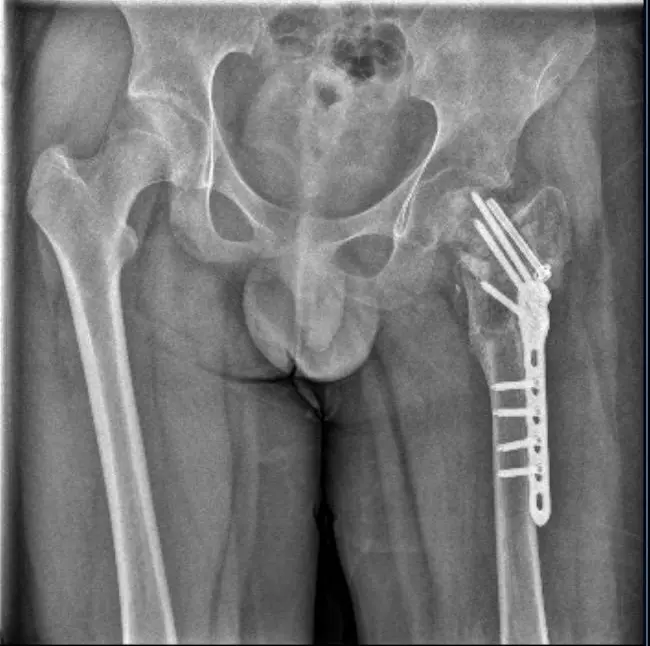 ▲小武左股骨陈旧性骨折,打了钢针、钢板 图据受访人