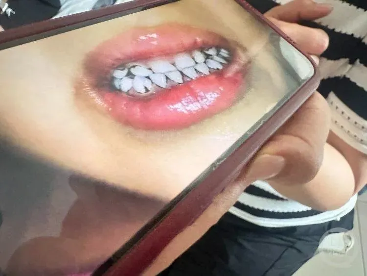 有幼儿牙龈出现黑色斑点。上游新闻记者 贾晨 摄