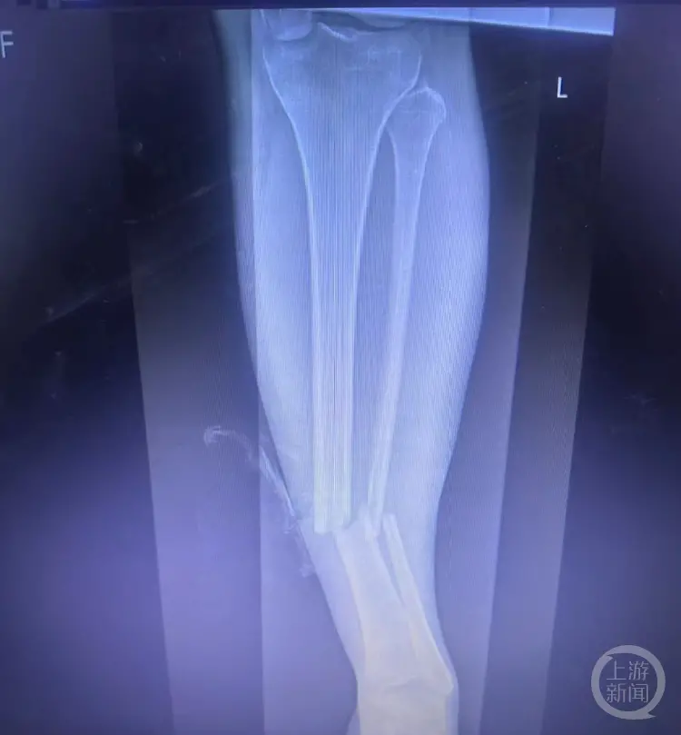 受伤小腿的CT照片。