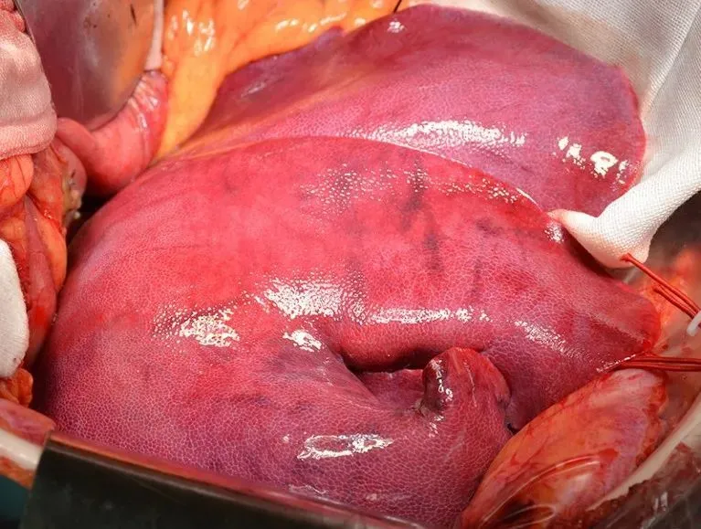 这次异种移植手术使用的猪肝。来源：中国西安空军军医大学西京医院