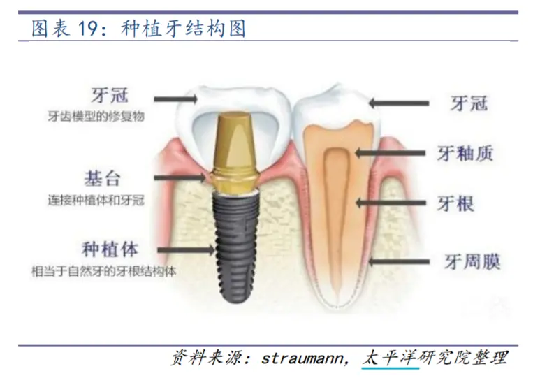 種植牙結(jié)構(gòu)圖 來自：太平洋證券研報(bào)
