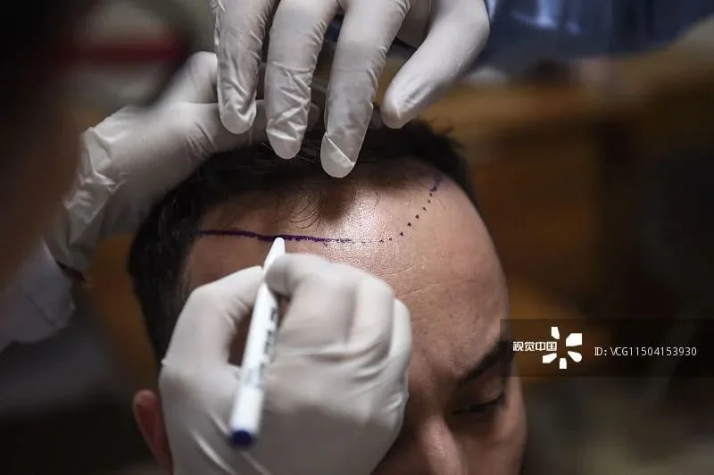 一位土耳其医生正在为患者植发/图源：视觉中国