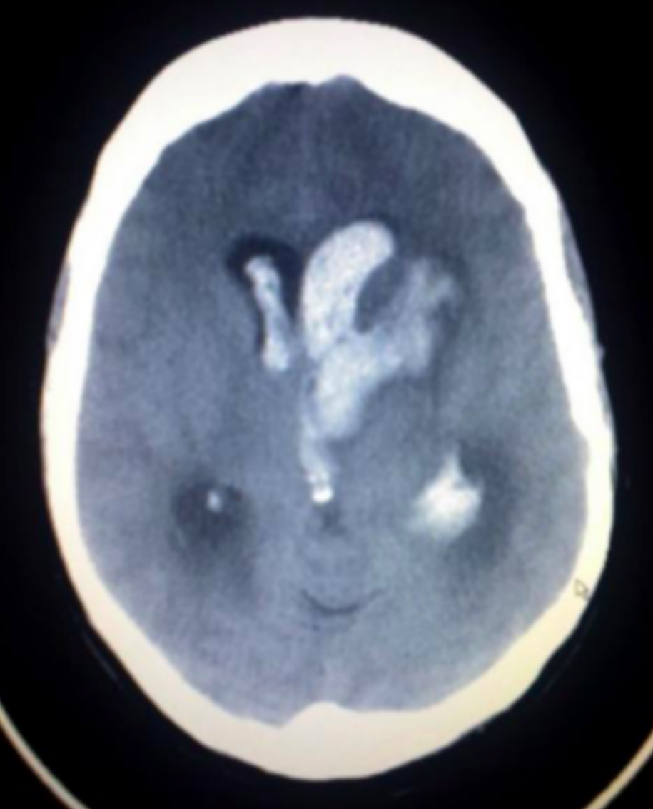 颅内出血 CT 表现（非此病例）图源：Wikipedia